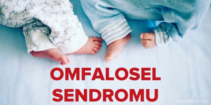 omfalosel sendromu